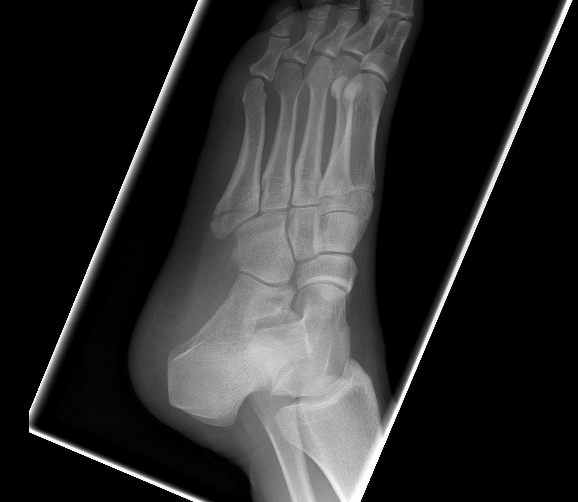 Fifth Metatarsal Undisplaced Avulsion Fracture